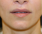Feel Beautiful - Upper Lip Lift & Lower Lip W-Plasty 211 - After Photo